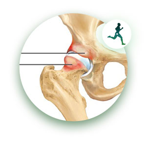 Impacto femoroacetabular