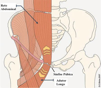 Pubalgia do Atleta - Dr. Anderson Luiz Oliveira
