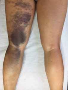 Hematoma na região posterior da coxa