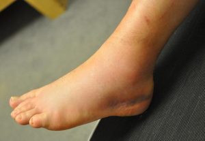 Hematomas e inchaço são sinais comuns de entorse no tornozelo. A gravidade dos sintomas varia dependendo do grau de lesão dos ligamentos.