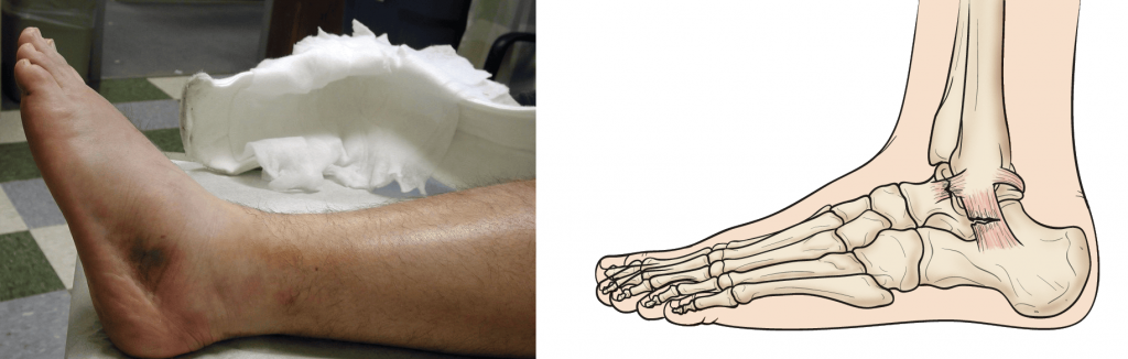 Uma entorse de grau 2 resulta em ruptura parcial dos ligamentos. Isso geralmente leva a inchaço moderado e hematomas acima e abaixo da articulação do tornozelo.