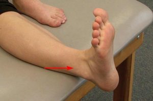 Para diagnosticar uma entorse, seu médico irá palpar suavemente estruturas ao redor do tornozelo na área da dor (seta).
