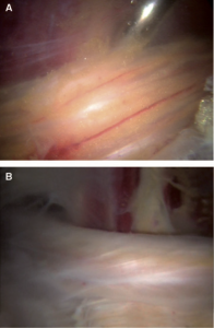 Fig. 8. Inspeção do nervo ciático. (A) Nervo ciático normal com presença de fluxo sanguíneo e gordura epineural. (B) Nervo ciático anormal com aparência esbranquiçada e sem gordura epineural.