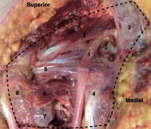 Fig. 2. Espaço Glúteo Profundo. Um quadril esquerdo cadavérico com o músculo Glúteo Máximo rebatido. O trajeto do Nervo Ciático (1) ao entrar na pelve (Espaço Glúteo Profundo) pela incisura ciática anteriormente ao músculo Piriforme (2) e ligamento Sacrotuberoso (3). À medida que o nervo se desloca distalmente em direção à origem dos músculos Isquiotibiais e do Ísquio (4), passa posteriormente ao complexo Gêmeos-Obturador Interno (5) e músculo Quadrado Femoral (6, nesta imagem com a porção inferior do músculo removida para expor o trocânter menor). Estruturas laterais incluem o Trocânter Menor (7) e Trocânter Maior (8).