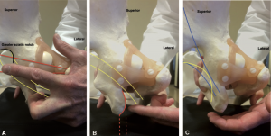 Fig. 5. Palpação do espaço glúteo profundo. (A) Na incisura ciática maior (contornada em preto). O trajeto do músculo piriforme (representado em vermelho) e o nervo ciático (representado em amarelo). (B) Lateral ao ísquio (linha vermelha sólida). O caminho dos tendões Isquiotibiais (linha vermelha tracejada) e nervo ciático (representado em amarelo). (C) Medial ao Ísquio. O caminho do ligamento Sacrotuberoso (representado em azul) e o nervo Pudendo (linha amarela).